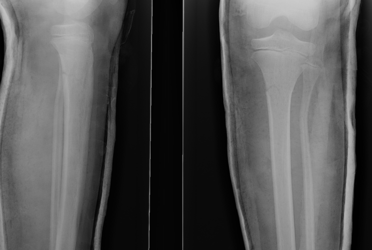 Paediatric Proximal Tibial Fracture